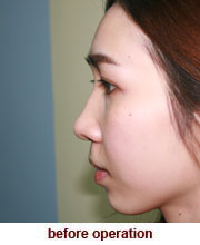 plastic_surgery_augmentation_rhinoplasty